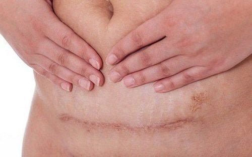 Fertility After Cesarean Section: What You Should Know