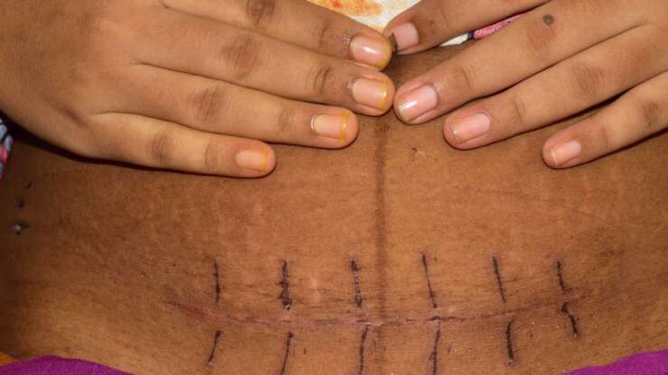 Pregnancy After a C-Section: Understanding Your Fertility and Family Planning
