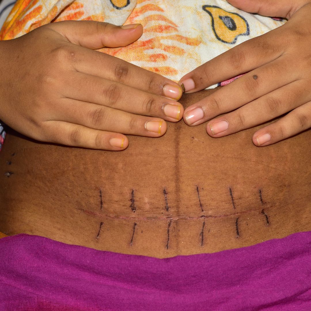 Pregnancy After a C-Section: Understanding Your Fertility and Family Planning